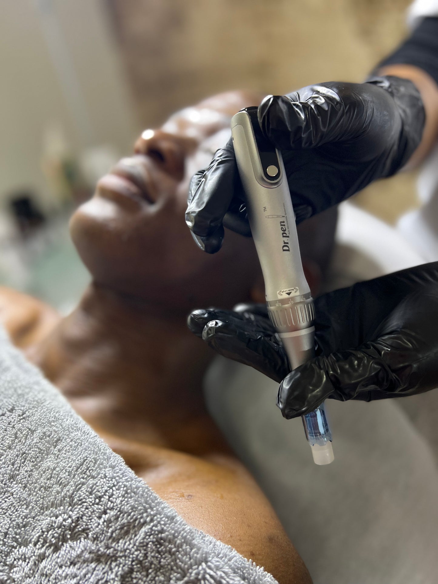 Microneedling Facial Treatment