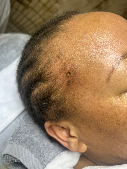 a picture of the skin tag scar after the skin tag was surgically removed